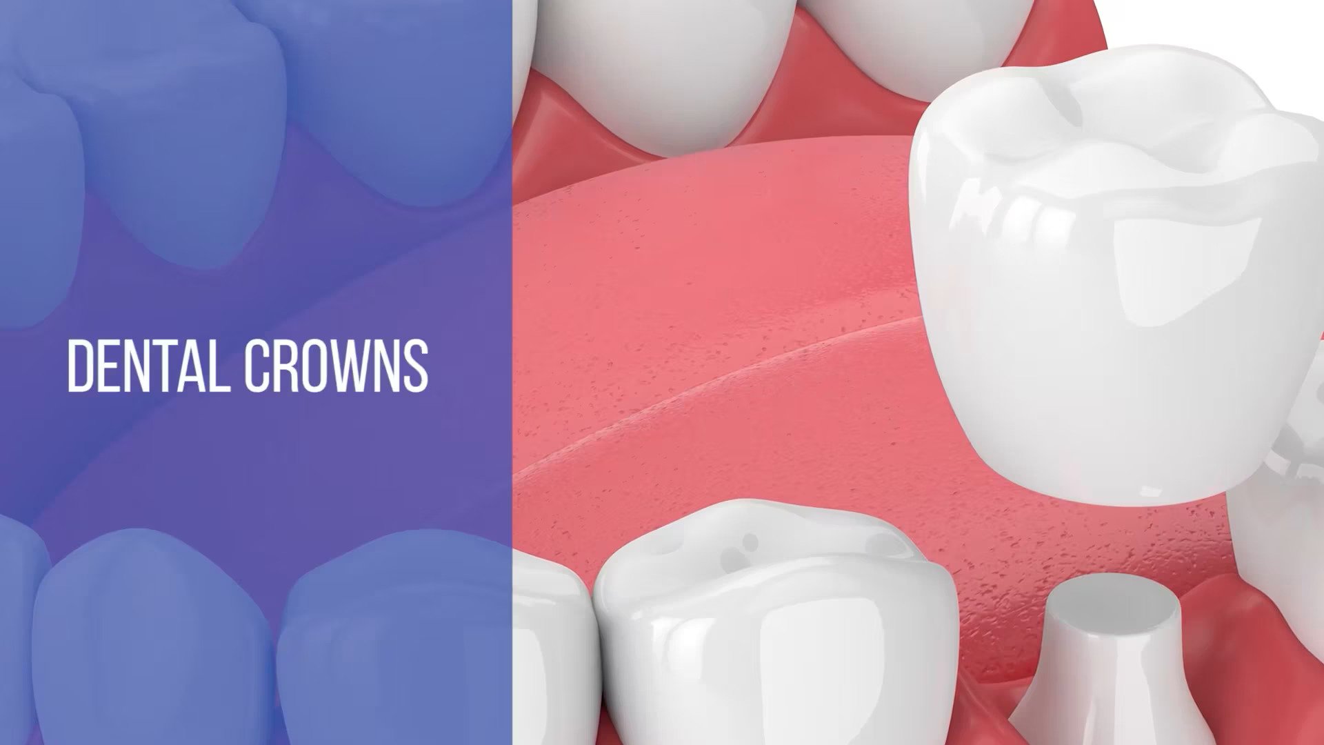 Dental Crowns Paxton - Worcester MA - Fix Chipped or Broken Tooth